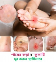 কর্ন ,বয়রা, হাড়কাঁটা, হাড়গোঁজা রিমুভার জেল
